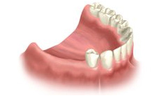 teeth replacement